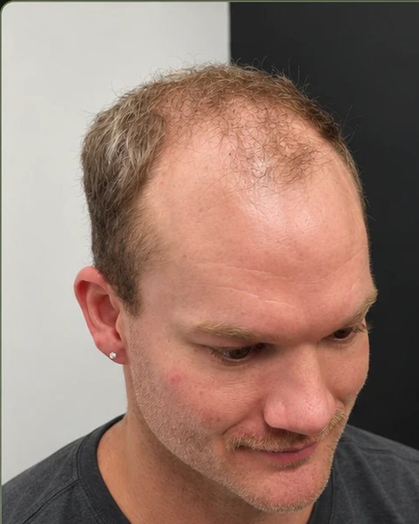 A Tuffs client before his hair system