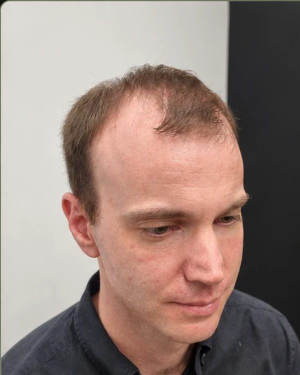 A Tuffs client before his hair system