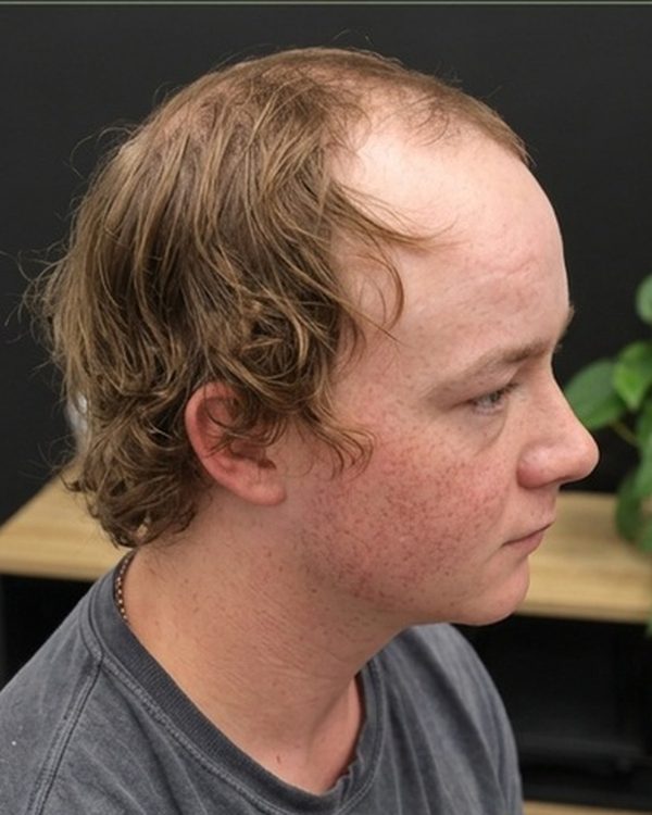 A Tuffs client before his hair system