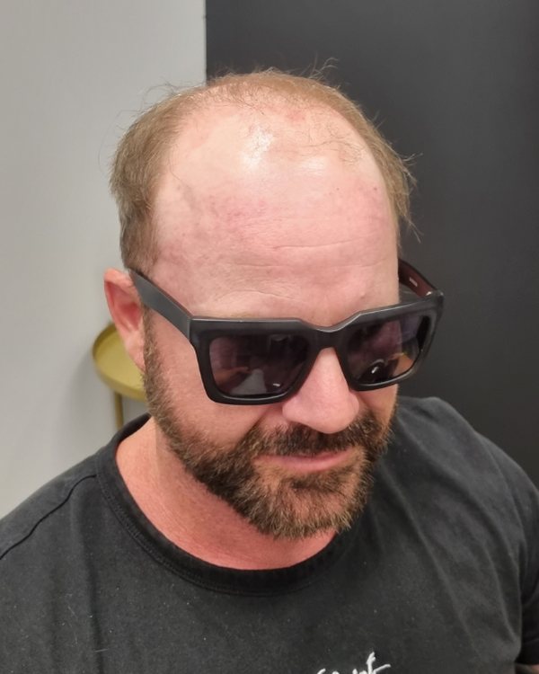 A Tuffs client before his hair system