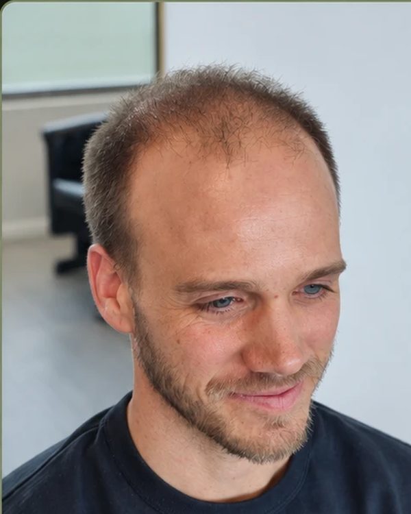 A Tuffs client before his hair system