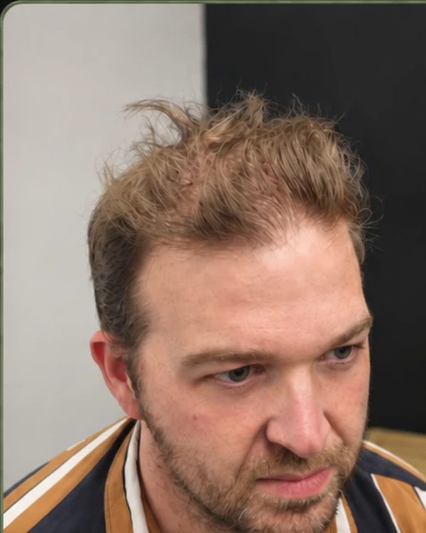 A Tuffs client before his hair system